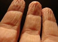 Smježurani prsti od vode za bolje hvatanje predmeta Smježurani prsti od vode za bolje hvatanje predmeta