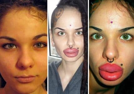 VIDEO: Žena sa najvećim usnama na svijetu VIDEO: Žena sa najvećim usnama na svijetu