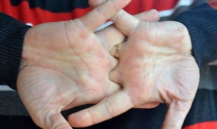 Da li je pucanje prstima štetno? Da li je pucanje prstima štetno?