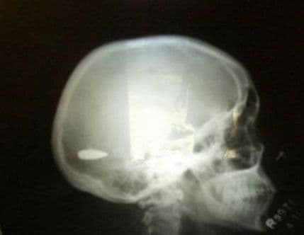 Golmana pogodio metak u glavu, on odigrao do kraja! Golmana pogodio metak u glavu, on odigrao do kraja!