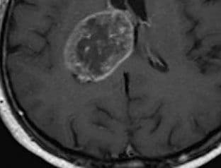 REVOLUCIJA U MEDICINI: Otkriven novi lijek koji ubija ćelije raka, a ne oštećuje zdravo tkivo REVOLUCIJA U MEDICINI: Otkriven novi lijek koji ubija ćelije raka, a ne oštećuje zdravo tkivo