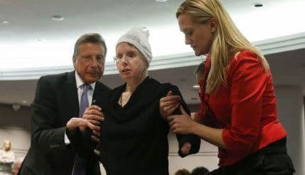 Žrtva napada šimpanze traži 150 miliona dolara odštete Žrtva napada šimpanze traži 150 miliona dolara odštete