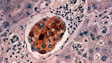 SAD: Virus malih boginja uništio rak SAD: Virus malih boginja uništio rak