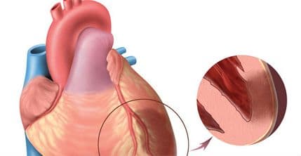 Žene imaju drugačije simptome infarkta od muškaraca Žene imaju drugačije simptome infarkta od muškaraca