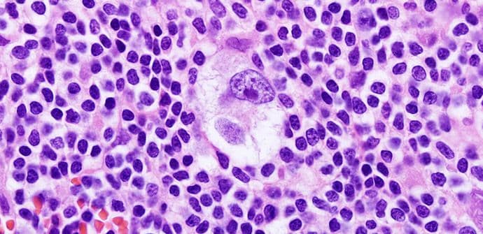 Novi lijek za Hodžkinov limfom pokazao odlične rezultate Novi lijek za Hodžkinov limfom pokazao odlične rezultate
