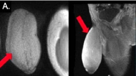 PRESEDAN: Prvi put u istoriji izvedena operacija smanjenja penisa PRESEDAN: Prvi put u istoriji izvedena operacija smanjenja penisa