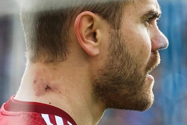 FOTO: Opekotina na vratu Igora Akinfijeva  FOTO: Opekotina na vratu Igora Akinfijeva