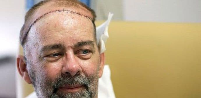 Teksas: Obavljena prva transplantacija lobanje Teksas: Obavljena prva transplantacija lobanje