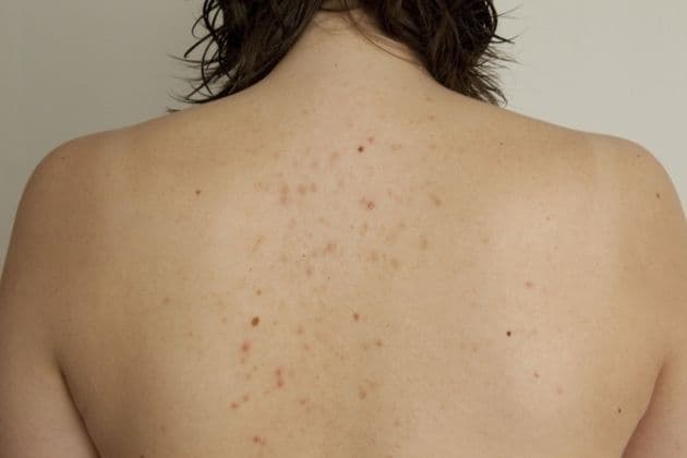 Izbacite ove namirnice i preparate ako želite da pobijedite bubuljice na leđima Izbacite ove namirnice i preparate ako želite da pobijedite bubuljice na leđima