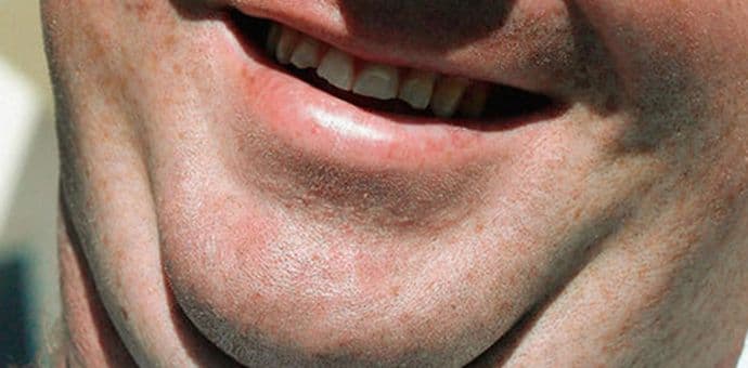 Savjeti koji će vam pomoći da se riješite podbratka Savjeti koji će vam pomoći da se riješite podbratka