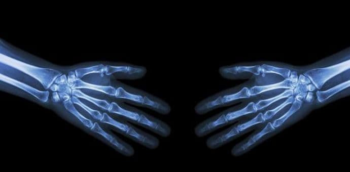 Dodatni kalcijum ne smanjuje rizik od loma kostiju Dodatni kalcijum ne smanjuje rizik od loma kostiju