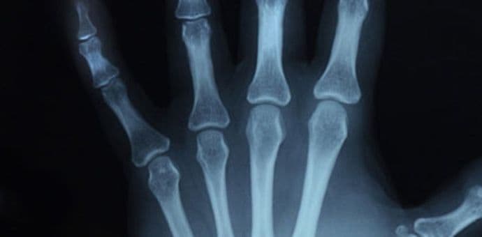 Kako spriječiti ili usporiti osteoporozu Kako spriječiti ili usporiti osteoporozu