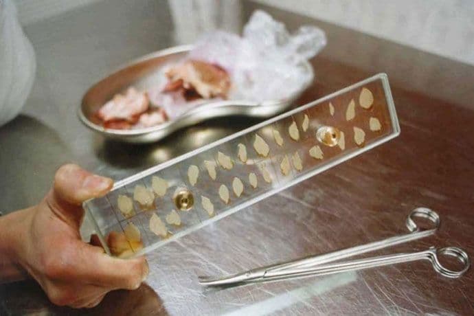 Zenica: Pacijent preminuo od svinjskog gripa Zenica: Pacijent preminuo od svinjskog gripa