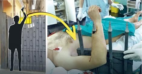 Ljekari Urgentnog centra operisali lopova nabijenog na šiljak Ljekari Urgentnog centra operisali lopova nabijenog na šiljak