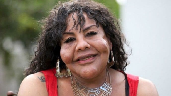 Ubrizgali su mu cement i lijepak u lice da bi bio lijepa žena Ubrizgali su mu cement i lijepak u lice da bi bio lijepa žena