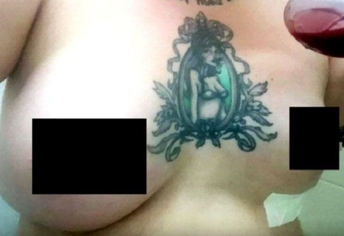 Povećala je grudi, a onda su silikoni eksplodirali Povećala je grudi, a onda su silikoni eksplodirali