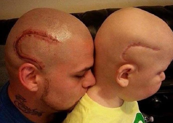 Najbolji otac: Istetovirao ožiljak kako bi bolesnom sinu ojačao samopouzdanje Najbolji otac: Istetovirao ožiljak kako bi bolesnom sinu ojačao samopouzdanje