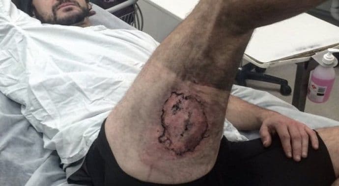 Zadobio teške opekotine: Nakon pada sa bicikla eksplodirao mu iPhone 6 Zadobio teške opekotine: Nakon pada sa bicikla eksplodirao mu iPhone 6