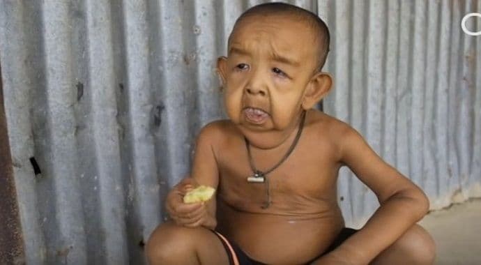 Rijetki poremećaj: Ima četiri godine i tijelo starca Rijetki poremećaj: Ima četiri godine i tijelo starca