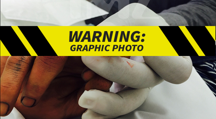 Uznemirujuće fotografije: Džoni Dep odsjekao sebi prst zbog nevjerstva Amber Herd (18+) Uznemirujuće fotografije: Džoni Dep odsjekao sebi prst zbog nevjerstva Amber Herd (18+)