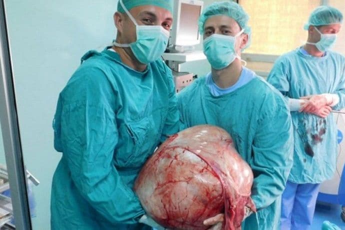 Banjaluka: Doktori odstranili tumor težak 31 kilogram Banjaluka: Doktori odstranili tumor težak 31 kilogram
