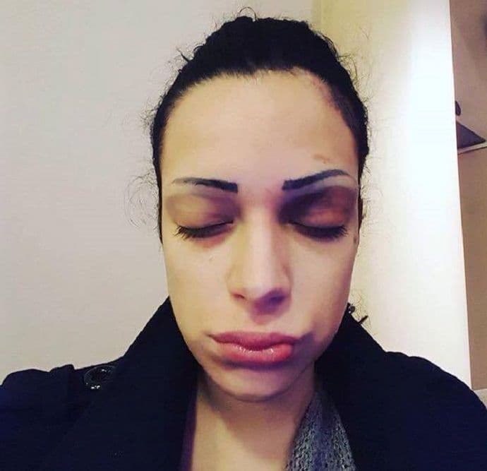 Pjevačica Dunja Ilić ponovo pretučena Pjevačica Dunja Ilić ponovo pretučena