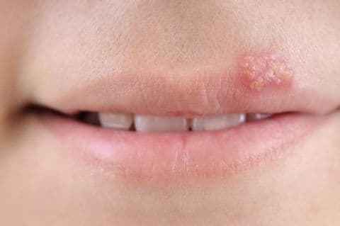 Jednostavan lijek za herpes, a kupuje se na pijaci! Jednostavan lijek za herpes, a kupuje se na pijaci!