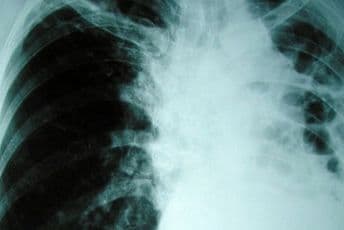 Tuberkuloza potvrđena kod šest osnovaca u Novom Pazaru Tuberkuloza potvrđena kod šest osnovaca u Novom Pazaru