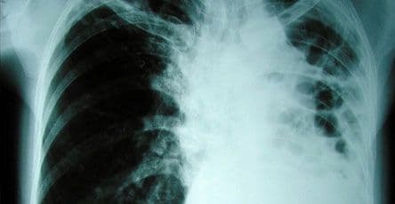 U petak se obilježava Svjetski dan borbe protiv tuberkuloze U petak se obilježava Svjetski dan borbe protiv tuberkuloze