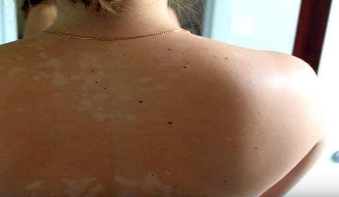 Imate bijele fleke od sunca? Ovo su prirodni ljekovi Imate bijele fleke od sunca? Ovo su prirodni ljekovi