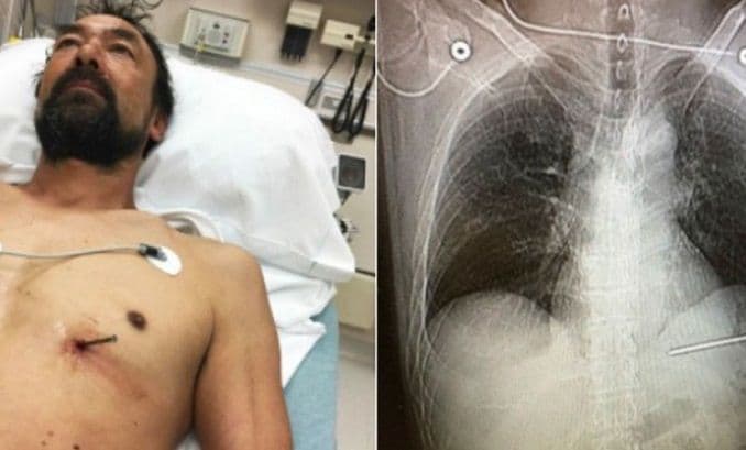 Zabio sebi ekser u srce, pa se odvezao u bolnicu Zabio sebi ekser u srce, pa se odvezao u bolnicu