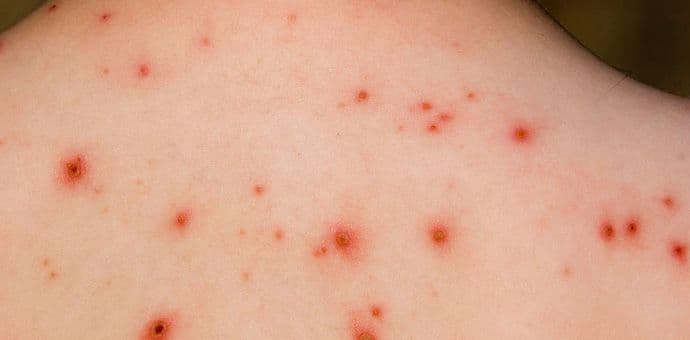 Blic: U Beogradu danas proglašavaju epidemiju malih boginja Blic: U Beogradu danas proglašavaju epidemiju malih boginja