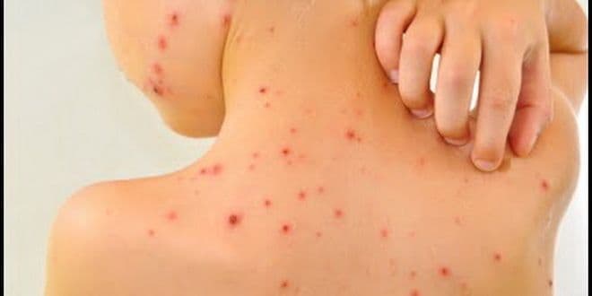 Što su morbile? Što su morbile?