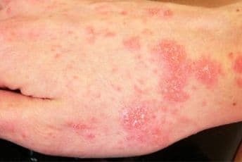 Tokom 2019. od šuge bolovalo 385 osoba Tokom 2019. od šuge bolovalo 385 osoba