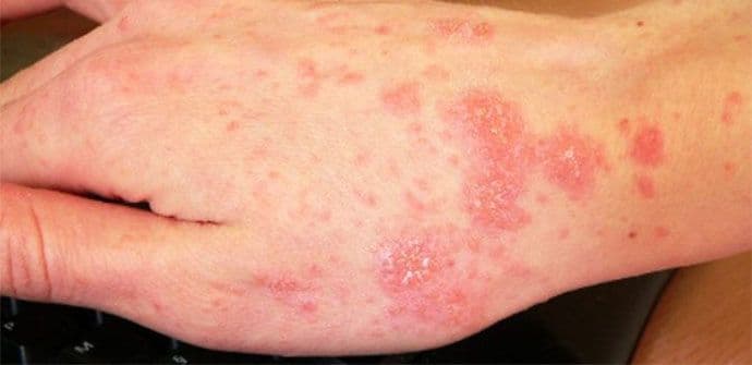 U novembru 77 osoba oboljelo od šuge U novembru 77 osoba oboljelo od šuge