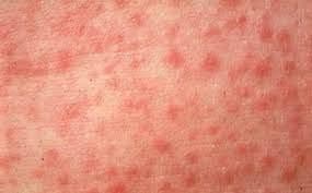 U bolnici pet osoba U bolnici pet osoba