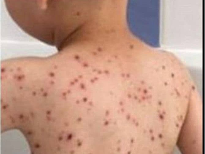 Djevojčica zaražena morbilama puštena kući Djevojčica zaražena morbilama puštena kući