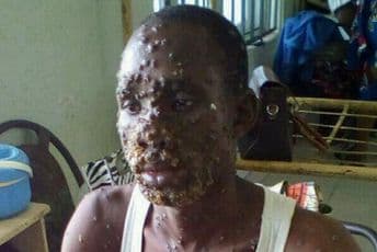 Svjetska zdravstvena organizacija sazvala hitan sastanak zbog majmunskih boginja Svjetska zdravstvena organizacija sazvala hitan sastanak zbog majmunskih boginja