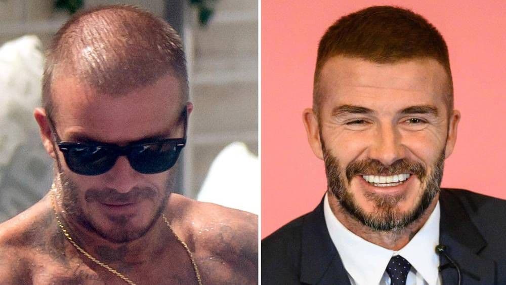 Bekam presadio kosu? Foto: Evening Standard