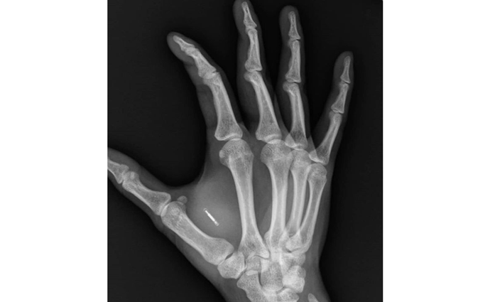 Više od 4.000 ljudi ugradilo čip u ruku Više od 4.000 ljudi ugradilo čip u ruku