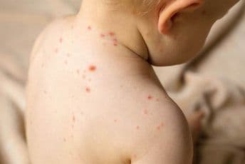 Ministarstvo pokreće kampanju MMR imunizacije Ministarstvo pokreće kampanju MMR imunizacije