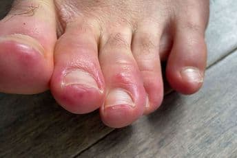 Otkriven još jedan simptom koronavirusa Otkriven još jedan simptom koronavirusa