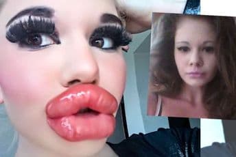 Bugarka hoće najveće usne na planeti Bugarka hoće najveće usne na planeti