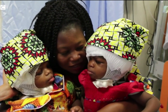 (VIDEO) Razdvojene sijamske bliznakinje koje su bile spojene lobanjama (VIDEO) Razdvojene sijamske bliznakinje koje su bile spojene lobanjama