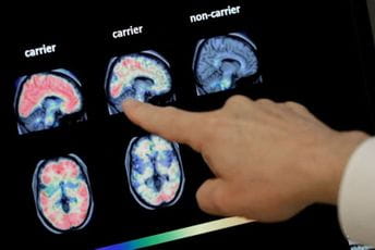 SAD odobrile prvi lijek protiv Alchajmerove bolesti SAD odobrile prvi lijek protiv Alchajmerove bolesti