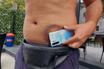 Martinović uvjeren da je pogođen gumenim metkom Martinović uvjeren da je pogođen gumenim metkom