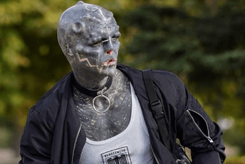 Muškarac koji želi izgledati kao "crni vanzemaljac" uklonio nos i gornju usnu Muškarac koji želi izgledati kao "crni vanzemaljac" uklonio nos i gornju usnu