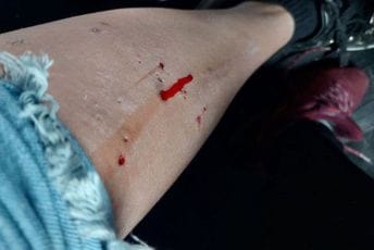 Kolašin: Psi lutalice napali djevojčicu u blizini školskog dvorišta Kolašin: Psi lutalice napali djevojčicu u blizini školskog dvorišta