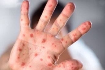 SZO: Države da povećaju nadzor, aktivno 200 slučajeva majmunskih boginja SZO: Države da povećaju nadzor, aktivno 200 slučajeva majmunskih boginja