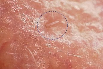 Ove grinje se razmnožavaju na našem licu, čiste nam kožu ali im prijeti izumiranje Ove grinje se razmnožavaju na našem licu, čiste nam kožu ali im prijeti izumiranje